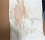 轻度子宫脱落下垂能做试管婴儿生孩子吗？